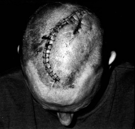 Paul Pritchard's severly injured head showing a long gash with many stitches